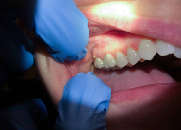 Best Emergency Wisdom Teeth Removal in Monette, AR